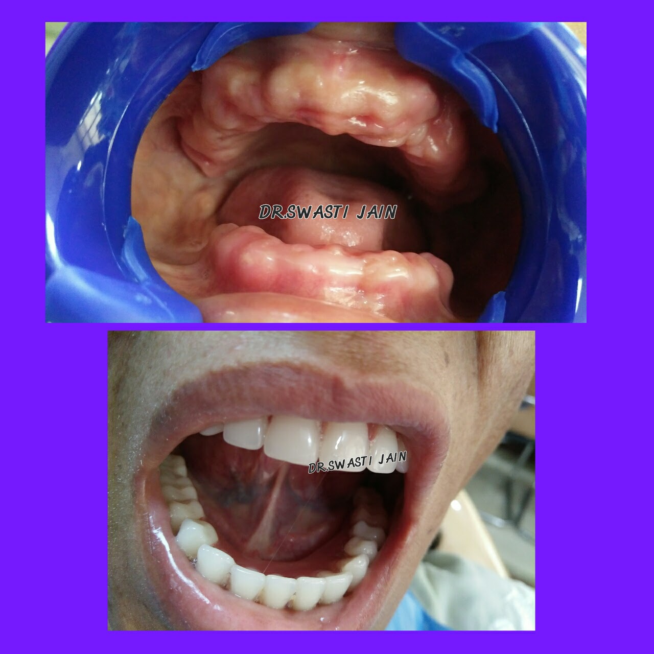 Geriatric Care/Dentures