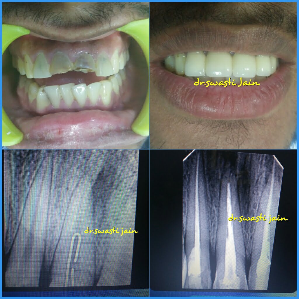 rct in vaishali
cost of root canal treatment in vaishali ghaziabad
painless rct in vaishali
rct with microscope in vaishali
root canal treatment in vaishali ghaziabad
painless root canal treatment near me
best dental clinic for rct near me