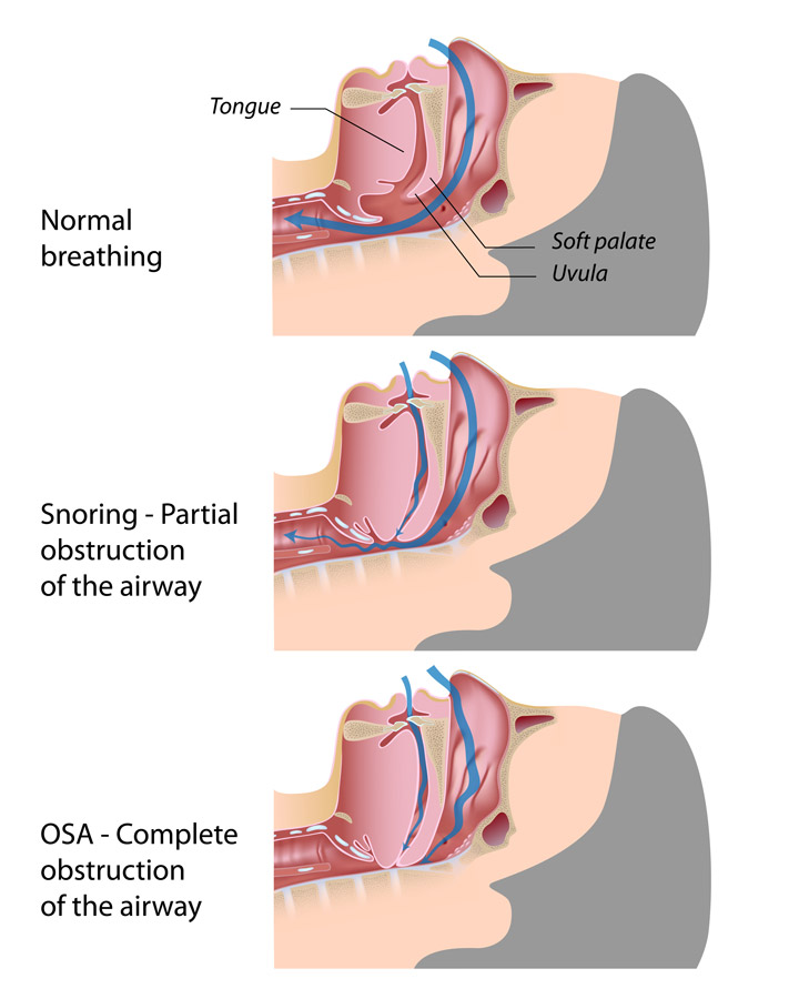 sleep apnea
obstructive sleep apnea in vaishali
anti snoring device in vaishali

