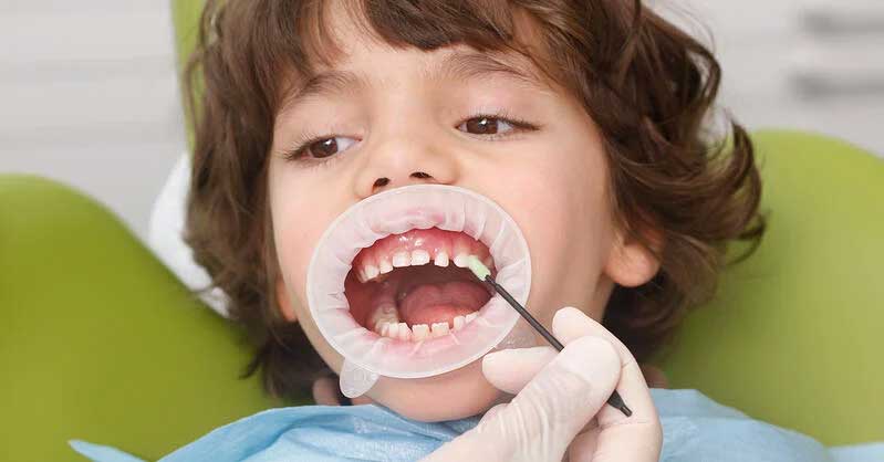 Fluoride Application Dentist in Vaishali
fluoride treatment for kids
fluoride treatment in vaishali ghaziabad