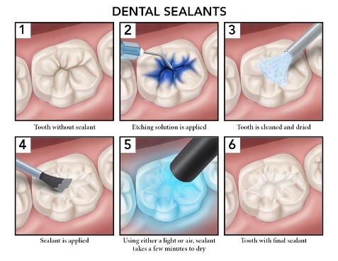 Tooth Sealants