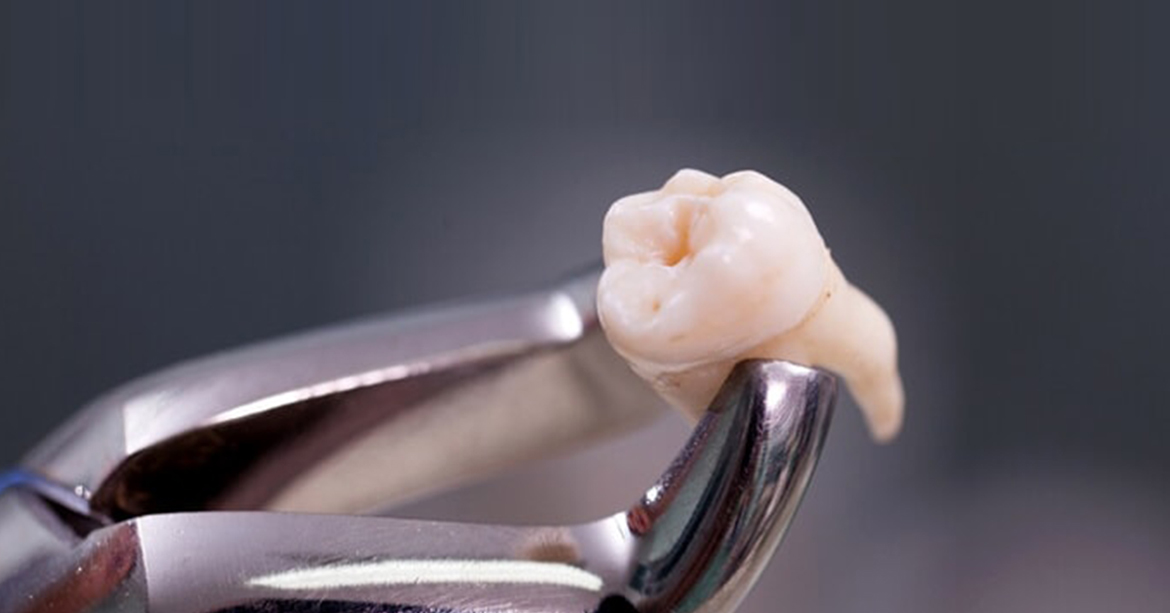 Wisdom Tooth Surgeries / 3rd Molar Removal