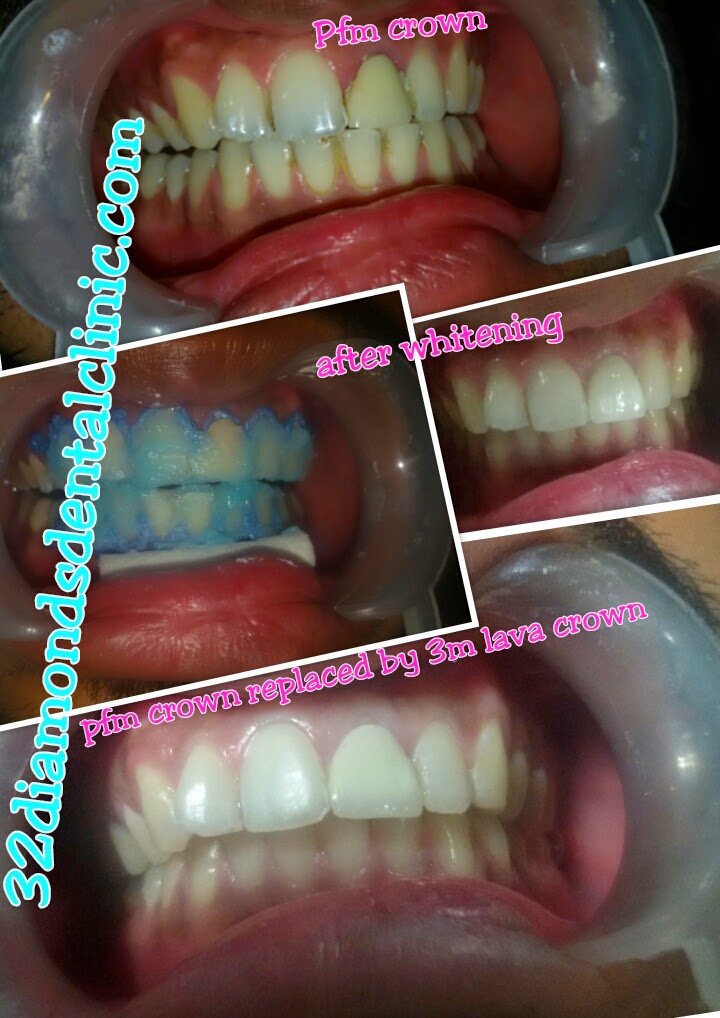 Tooth Whitening Dentist in Vaishali
teeth whitening in ghaziabad
teeth whitening in indrapuram
laser teeth whitening near me
best dental clinic for teeth whitening near me