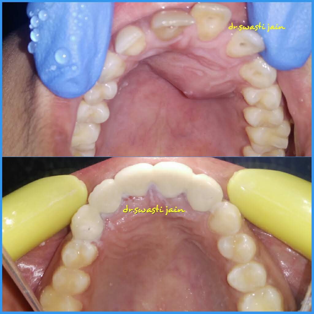 Gum Care Dentist in Vaishali
dentist for gum problems in vaishali
treatment of swollen gums near me
treatment of bleeding gums in vaishali ghaziabad
tartar removal in vaishali
receeding gums treatment in vaishali 