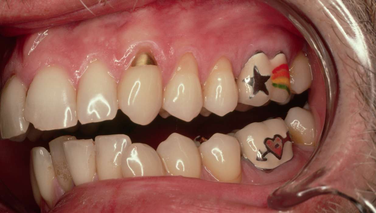 Is Tooth Fashion on The Rise  Stensland Dental Studio
