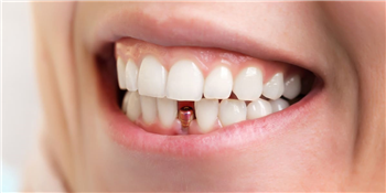 Painless Tooth Replacement - Dental Implants