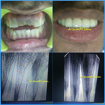 Painless Root Canal Treatment / RCT